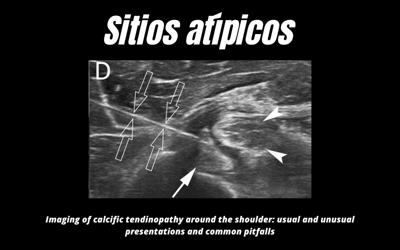 Sitio Atipico Calcificacion Ecografia 10.png